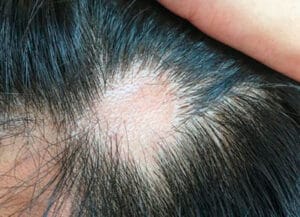 Tratar queda de cabelo com produto natural.