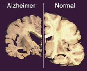 mal-de-alzheimer-sintomas